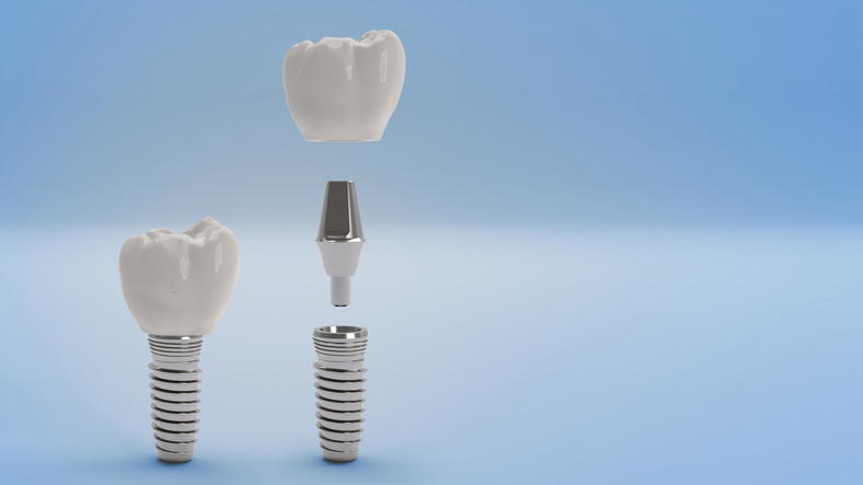 Coroas e próteses dentárias: cuidados após o tratamento